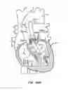 Fig. 55 - Low profile heart valve and delivery system