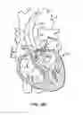 Fig. 56 - Low profile heart valve and delivery system