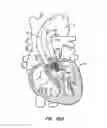 Fig. 57 - Low profile heart valve and delivery system