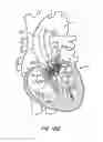 Fig. 58 - Low profile heart valve and delivery system