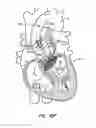 Fig. 59 - Low profile heart valve and delivery system