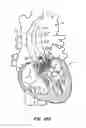 Fig. 60 - Low profile heart valve and delivery system