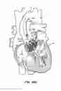 Fig. 61 - Low profile heart valve and delivery system