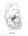 Fig. 62 - Low profile heart valve and delivery system