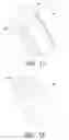 Fig. 11 - Milled bone graft materials and methods of use