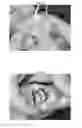 Fig. 04 - MENISCUS FOR JOINT RECONSTRUCTION