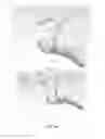 Fig. 10 - Partial joint resurfacing implant, instrumentation, and method