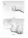 Fig. 11 - Partial joint resurfacing implant, instrumentation, and method