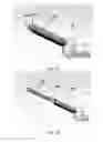 Fig. 12 - Partial joint resurfacing implant, instrumentation, and method