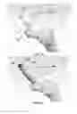 Fig. 14 - Partial joint resurfacing implant, instrumentation, and method