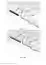 Fig. 15 - Partial joint resurfacing implant, instrumentation, and method