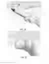 Fig. 16 - Partial joint resurfacing implant, instrumentation, and method