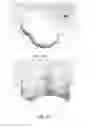 Fig. 17 - Partial joint resurfacing implant, instrumentation, and method