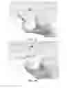 Fig. 18 - Partial joint resurfacing implant, instrumentation, and method