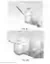 Fig. 19 - Partial joint resurfacing implant, instrumentation, and method