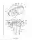 Fig. 02 - Tibial prosthesis with a fixed bearing component
