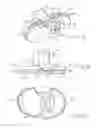 Fig. 03 - Tibial prosthesis with a fixed bearing component