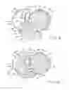 Fig. 05 - Tibial prosthesis with a fixed bearing component