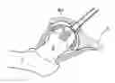 Fig. 01 - Hip joint instrument and method