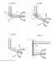 Fig. 16 - Hip joint instrument and method