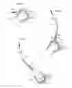 Fig. 27 - Hip joint instrument and method