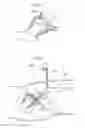Fig. 33 - Hip joint instrument and method