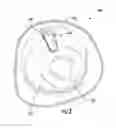 Fig. 04 - Attachment system for prosthetic device
