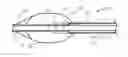 Fig. 01 - Treating endoleakages in aortic aneurysm repairs
