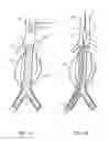 Fig. 02 - Treating endoleakages in aortic aneurysm repairs