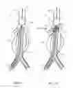 Fig. 03 - Treating endoleakages in aortic aneurysm repairs