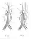 Fig. 04 - Treating endoleakages in aortic aneurysm repairs