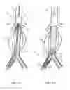 Fig. 05 - Treating endoleakages in aortic aneurysm repairs
