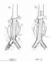 Fig. 06 - Treating endoleakages in aortic aneurysm repairs