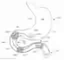 Fig. 01 - Conforming anchor for duodenal barrier