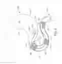 Fig. 05 - Conforming anchor for duodenal barrier