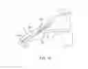Fig. 07 - Delivery system for ocular implant