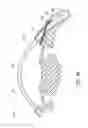 Fig. 13 - Intraocular shunt delivery
