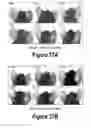 Fig. 15 - Molecular and Herbal Combinations for Treating Psoriasis
