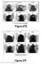 Fig. 17 - Molecular and Herbal Combinations for Treating Psoriasis