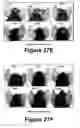 Fig. 17 - Molecular and herbal combinations for treating psoriasis