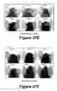 Fig. 17 - Molecular and herbal combinations for treating psoriasis