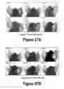 Fig. 15 - Molecular and Herbal Combinations for Treating Psoriasis
