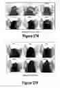 Fig. 17 - Molecular and Herbal Combinations for Treating Psoriasis