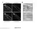 Fig. 21 - NGAL AND URINARY TRACT INFECTION