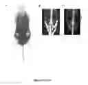 Fig. 32 - NGAL AND URINARY TRACT INFECTION