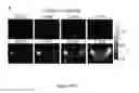 Fig. 33 - NGAL AND URINARY TRACT INFECTION