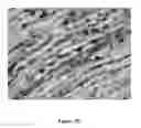Fig. 38 - NGAL AND URINARY TRACT INFECTION