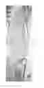 Fig. 09 - Moldable bone graft compositions
