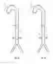 Fig. 13 - Intra-aortic balloon apparatus, assist devices and methods for improving flow, counterpulsation and haemodynamics