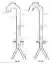 Fig. 19 - Intra-aortic balloon apparatus, assist devices and methods for improving flow, counterpulsation and haemodynamics